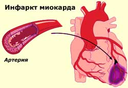 Жителей Москвы будут лечить от инфаркта миокарда новыми методами